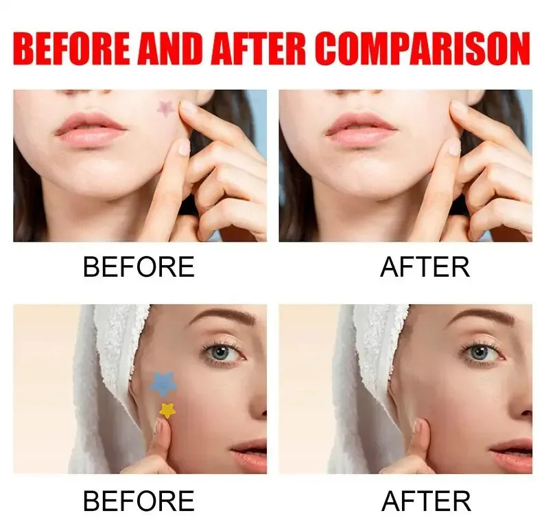 200pcs Repair Acne Patch Facial Skin Care Fade Blemishes Pimple Marks Closed Acne Blemishes Cover Acne Pimple Repair Patch